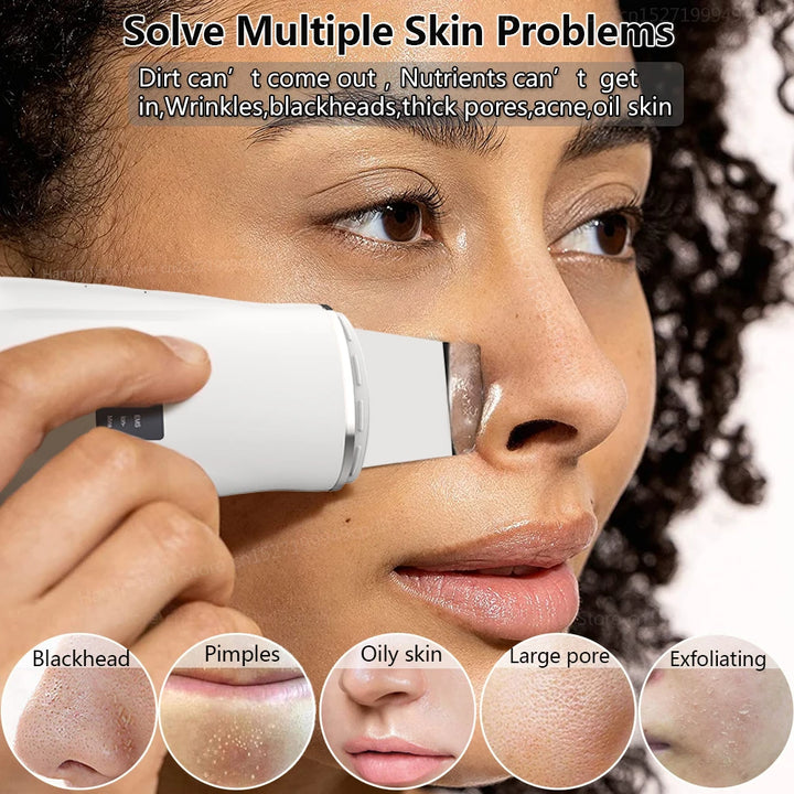 Ultrasonic Peeling Remover Blackhead Facial Skin Scrubber